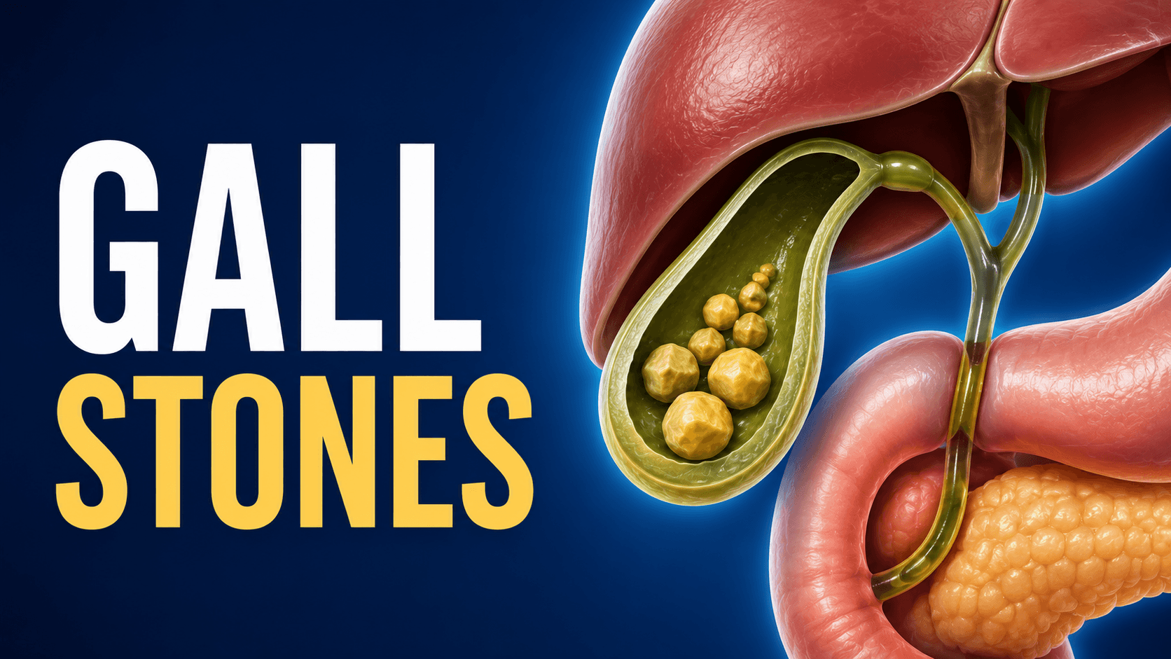 Gall Stones