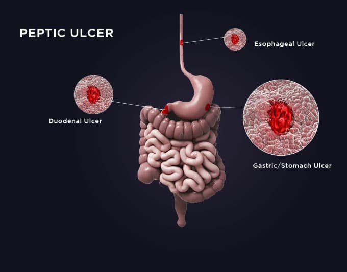 Peptic Ulcer