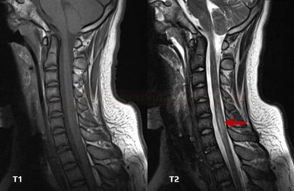 Transverse Myelitis