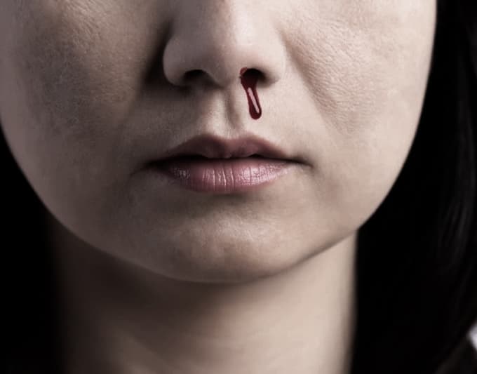 Case History – Hemophiliacs