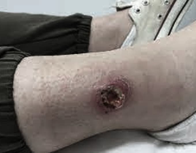 Non-Healing Ulcers