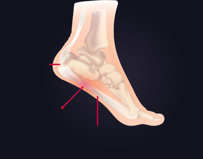 Plantar Fasciitis treatment placeholder