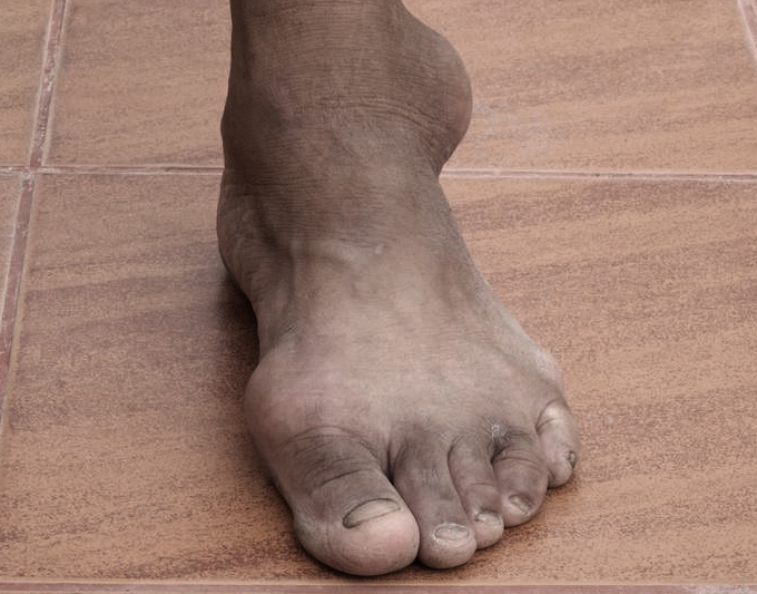 Gout treatment placeholder