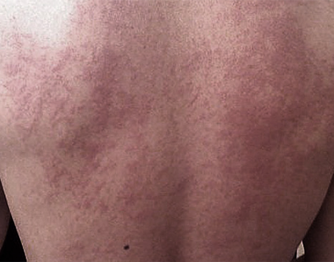 Bleeding Disorders treatment placeholder
