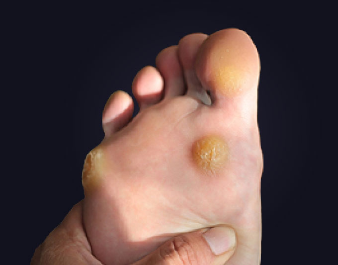 Plantar Corns treatment placeholder